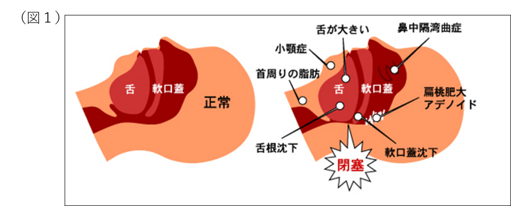 沈下性肺炎